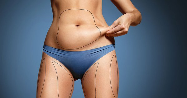 Der Einfluss des BMI auf die Fettabsaugung: Was du vor deinem Eingriff wissen musst