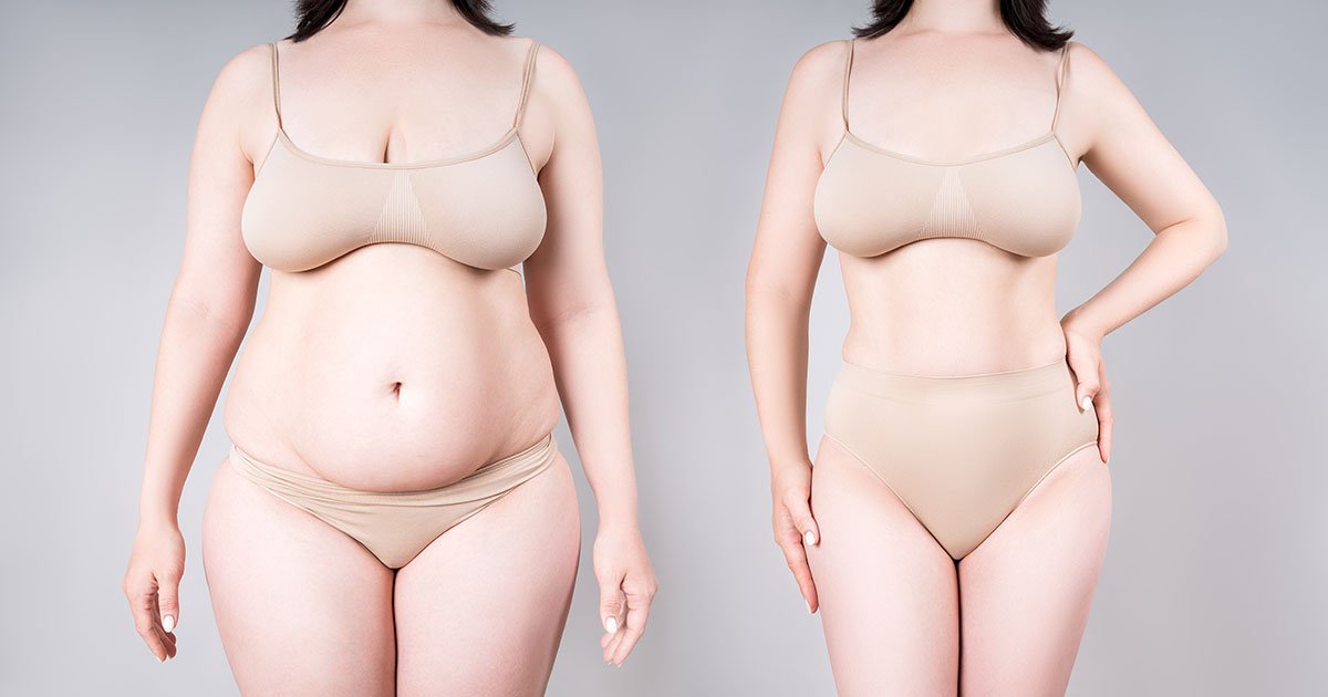 Mythen rund um die Fettabsaugung: Was stimmt wirklich?