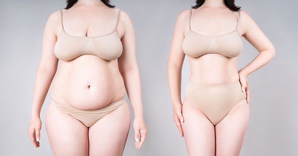 Mythen rund um die Fettabsaugung: Was stimmt wirklich?