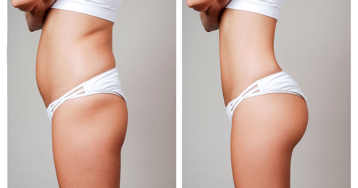 Wie lange hält das Ergebnis einer Fettabsaugung?