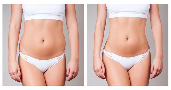 Fettabsaugung: Häufige Fragen beantwortet